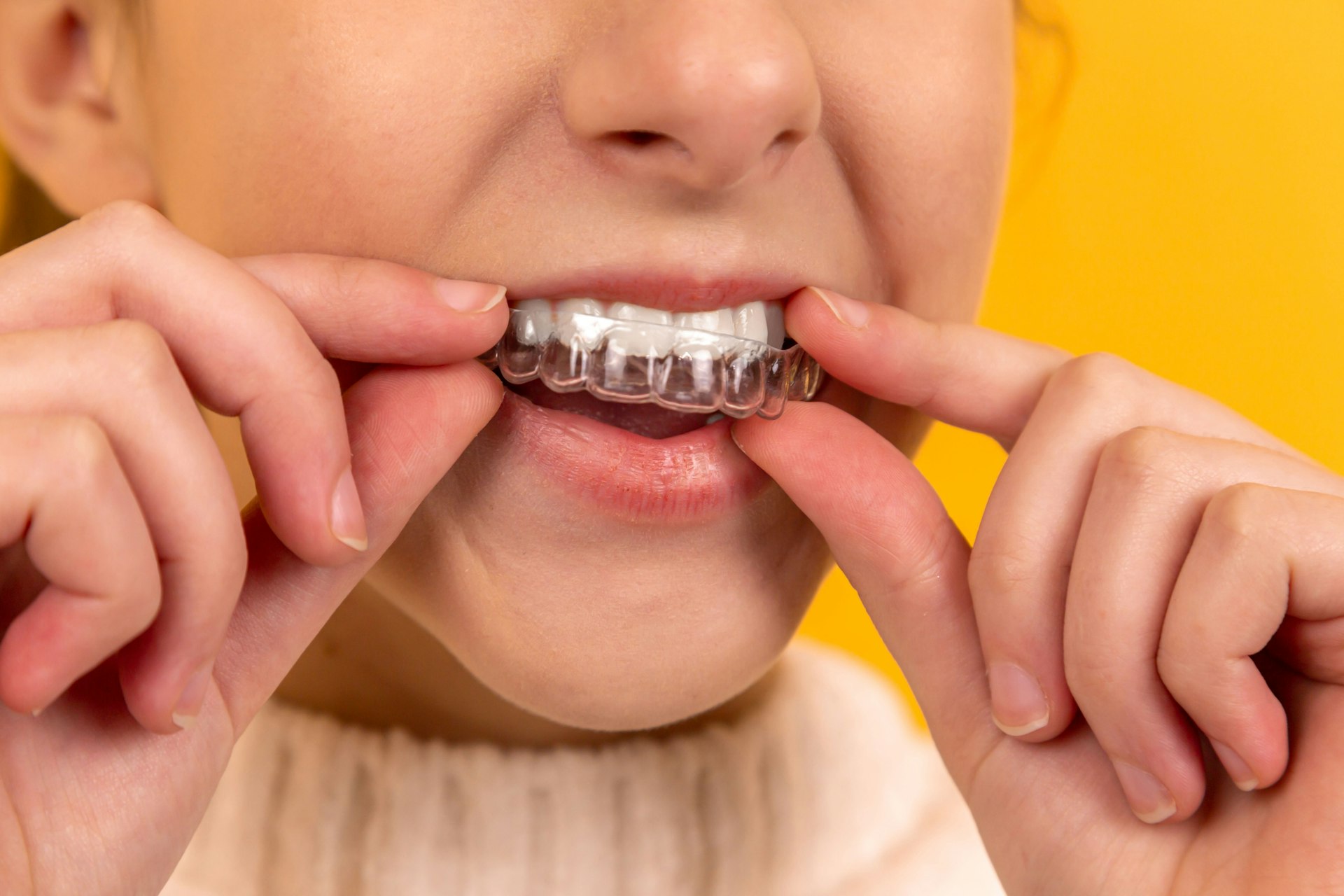 Implantes Dentários